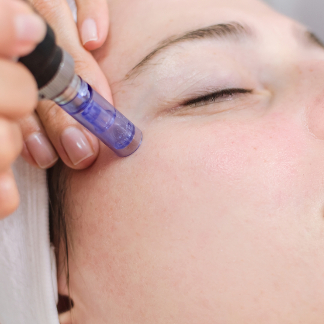 Microneedling