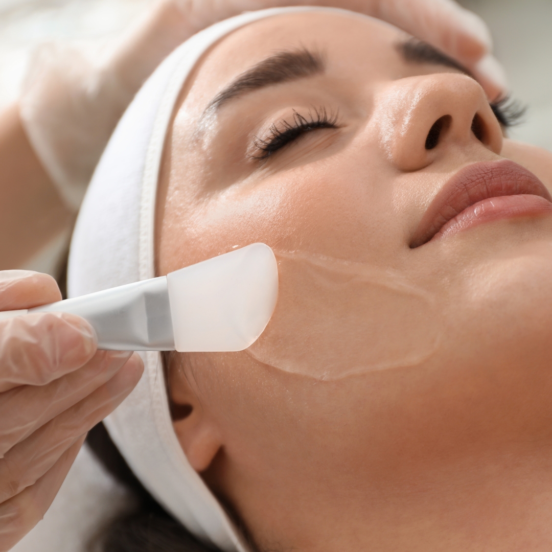 Chemical Peels